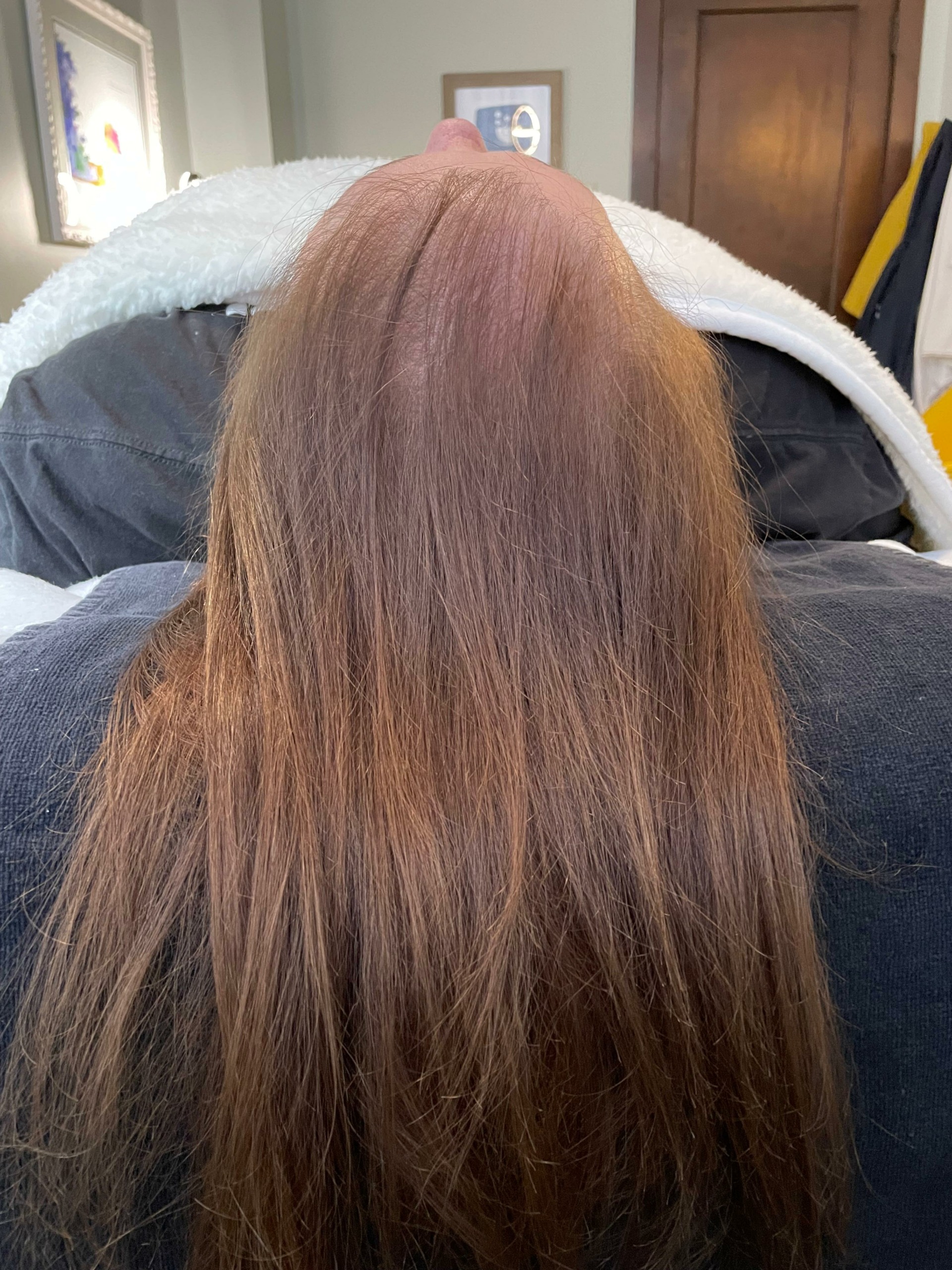 Vorher: lichter Scheitel mit sichtbarer Kopfhaut vor der HydraScalp-Behandlung