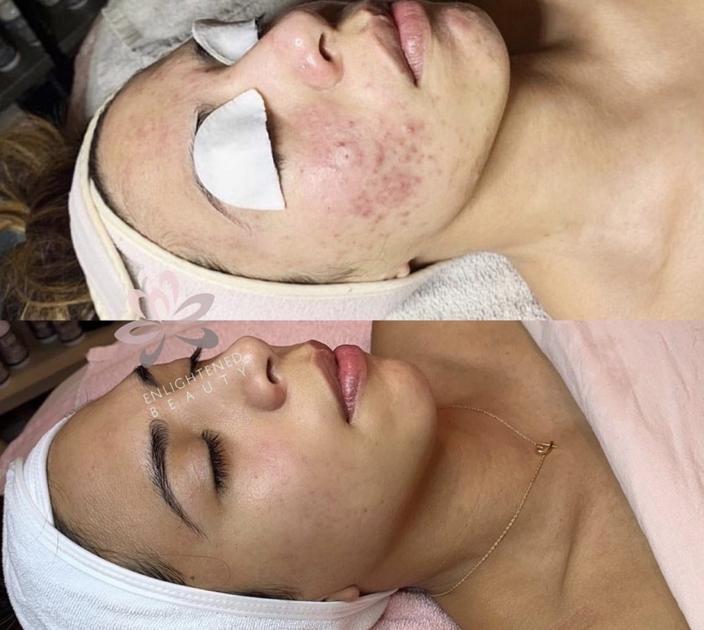 Vorher-Nachher: Akne an Wange und Kinn (oben), deutlich reinere Haut nach Hydrafacial (unten)