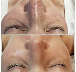 Vorher-Nachher an der Nase: verstopfte Poren und Mitesser (links), gereinigte Poren nach Hydrafacial (rechts)