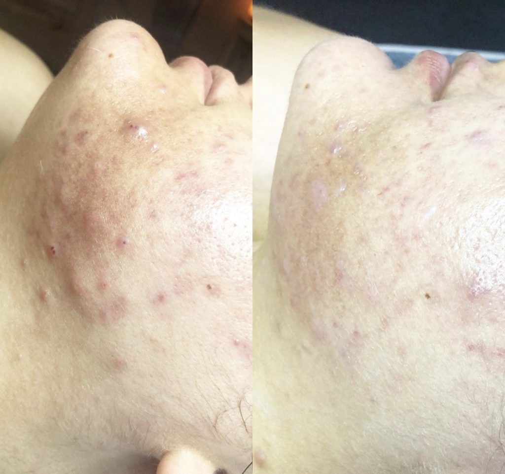Vorher-Nachher an Kinn und Kieferlinie: entzündliche Akne (links), weniger Entzündungen nach Hydrafacial (rechts)
