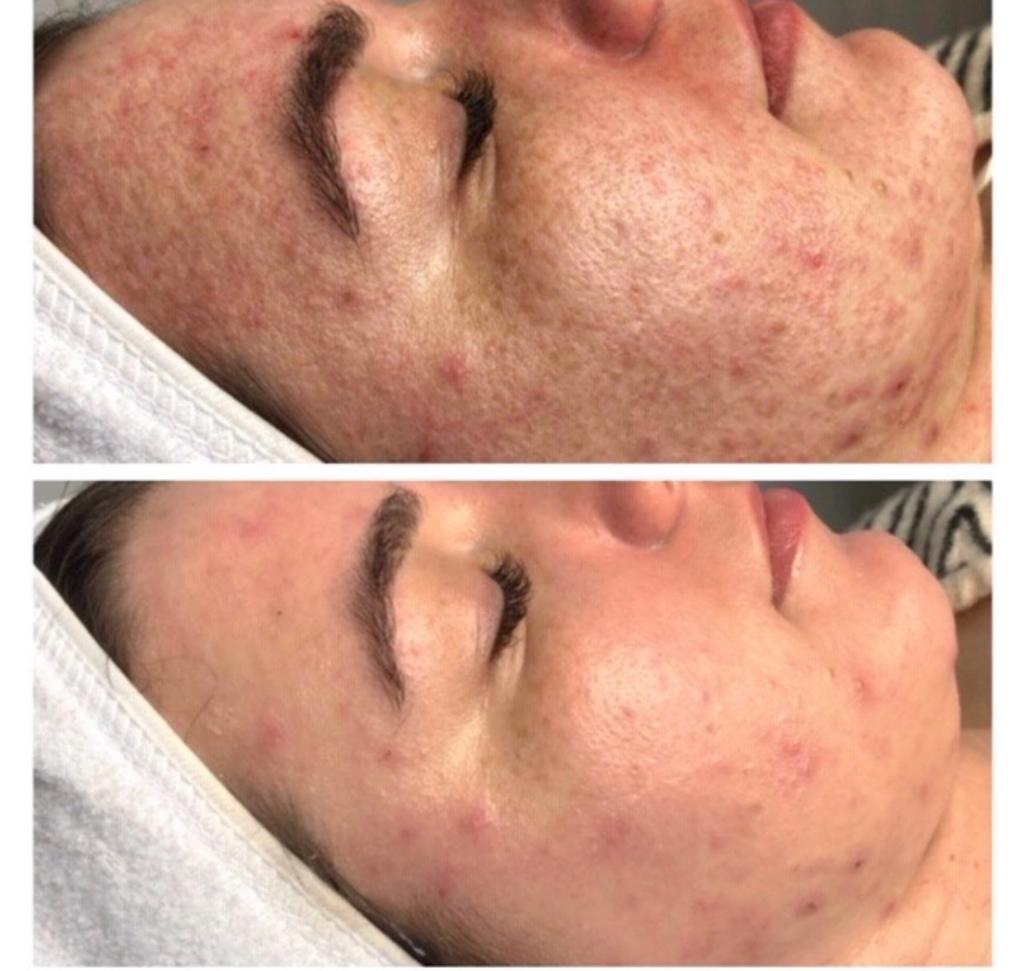 Vorher-Nachher an Wange und Kinn: Akne mit Rötungen (oben), ruhigeres Hautbild nach Hydrafacial (unten)