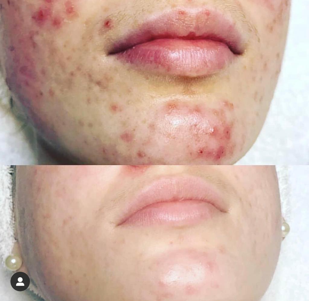 Vorher-Nachher an Kinn und Mundpartie: zahlreiche entzündete Pickel (oben), reineres, beruhigtes Hautbild nach Hydrafacial (unten)