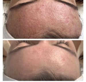 Vorher-Nachher an der Stirn: raue, gerötete Haut mit vergrößerten Poren (oben), glattere Stirn nach Hydrafacial (unten)
