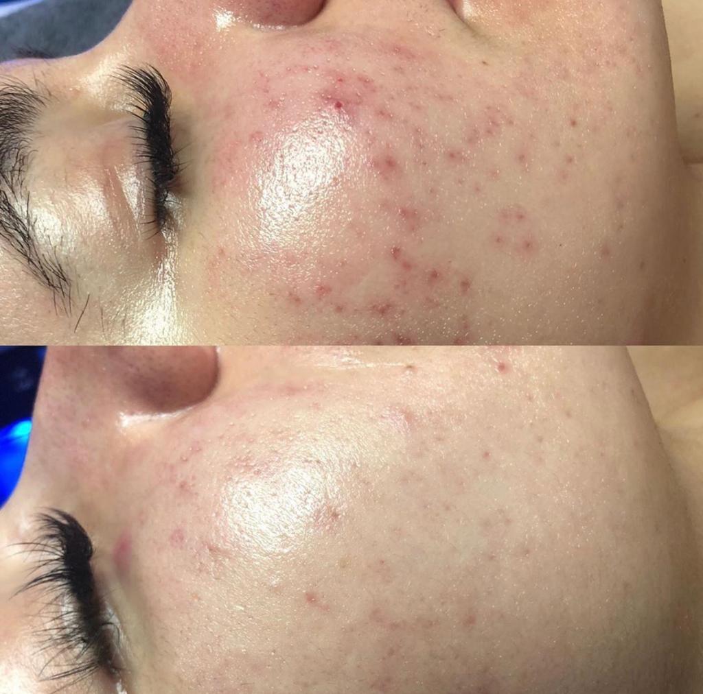 Vorher-Nachher an der Wange: viele kleine Pickel und Rötungen (oben), glatteres, reineres Hautbild nach Hydrafacial (unten)