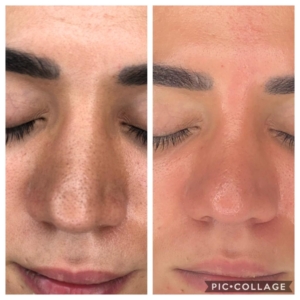 Vorher-Nachher an der Nase: deutlich vergrößerte Poren (links), verfeinerte Poren nach Hydrafacial (rechts)