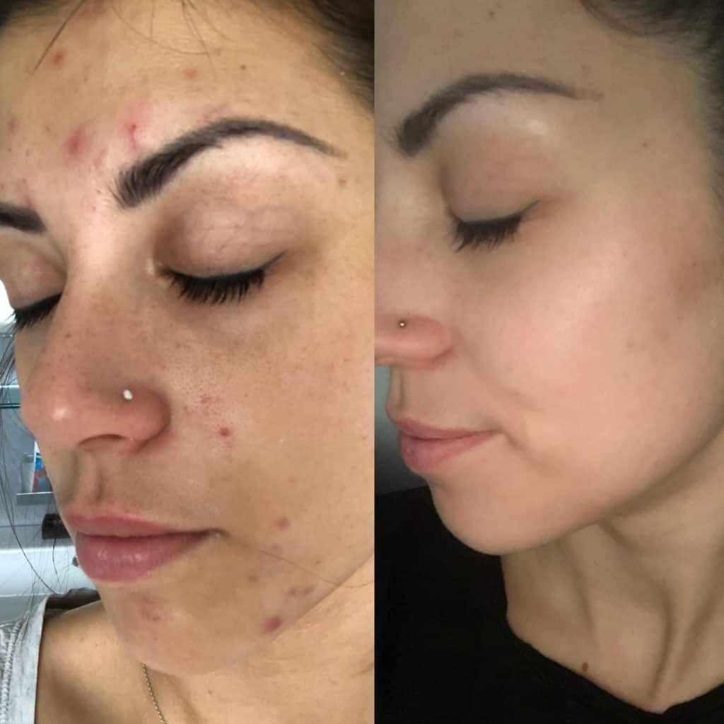 Vorher-Nachher im Profil: Pickel an Stirn, Wange und Kinn (links), klare, ebenmäßige Haut nach Hydrafacial (rechts)