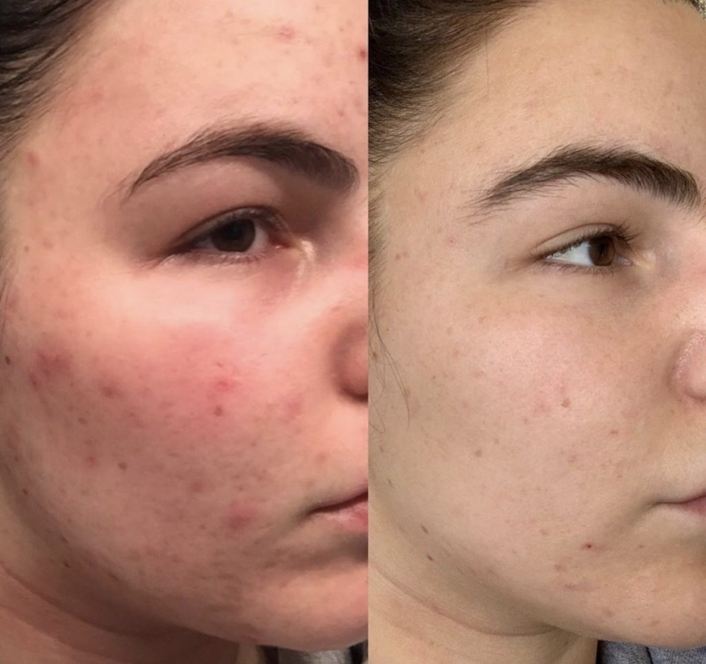 Vorher-Nachher an der Wange: gerötete Haut mit Akne (links), ruhigerer, gleichmäßiger Teint nach Hydrafacial (rechts)
