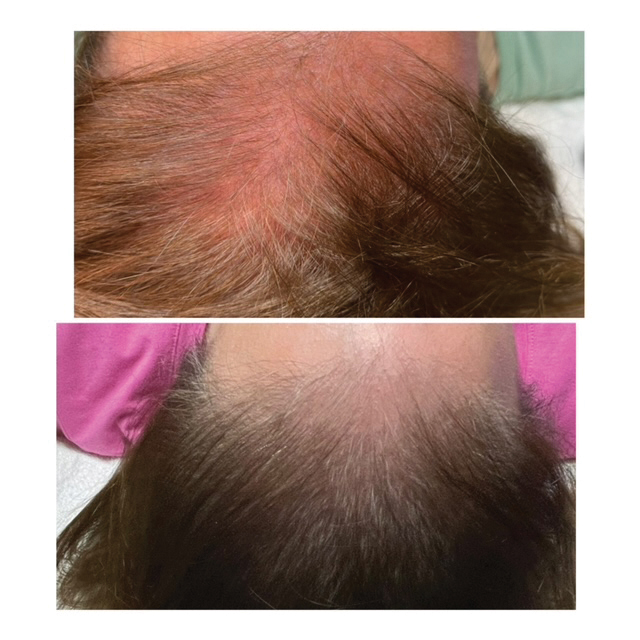 Vorher-Nachher-Vergleich: lichter Scheitel mit durchscheinender Kopfhaut (oben) und dichteres Haar nach mehreren HydraScalp-Behandlungen (unten)