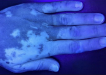 Hand mit Vitiligo