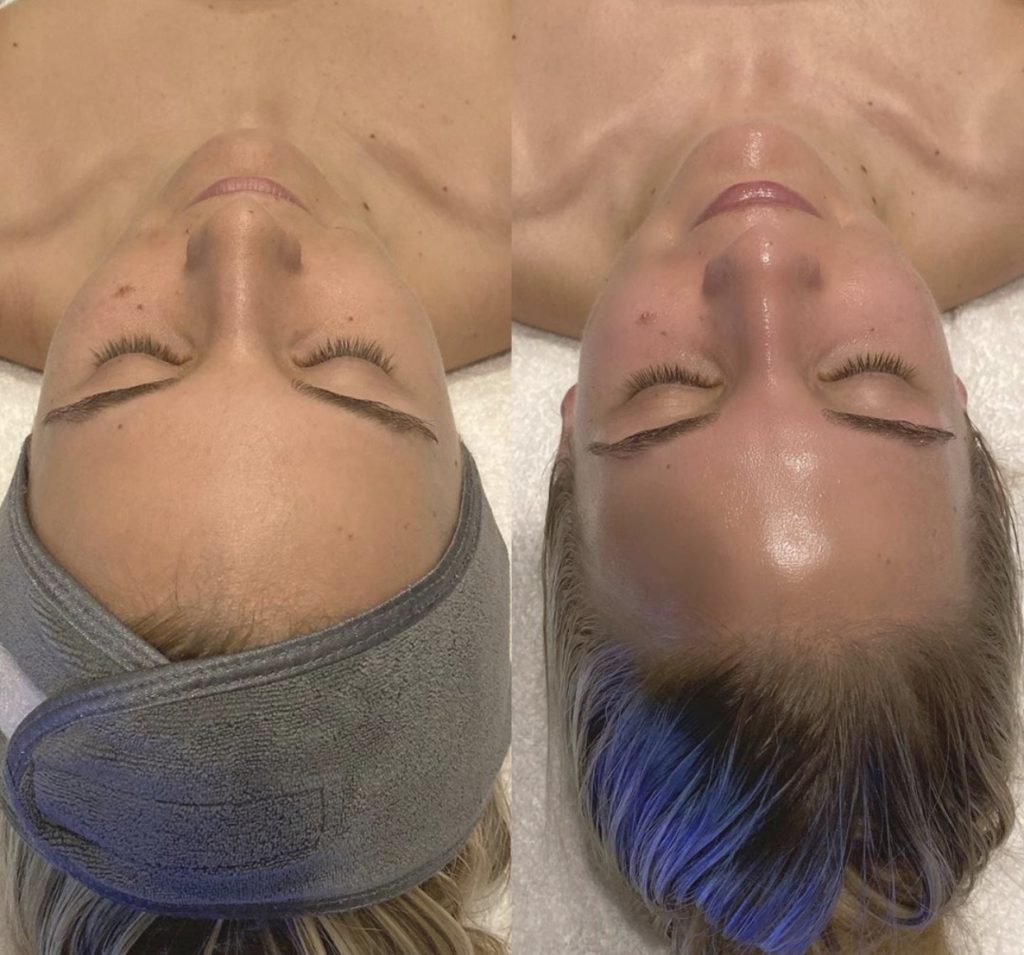 Vorher-Nachher-Vergleich: trockene Gesichtshaut vor und nach 2 Hydrafacial-Behandlungen