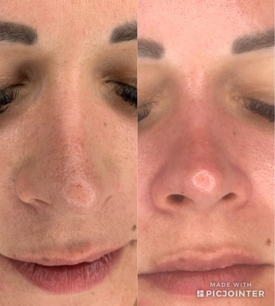 Vorher-Nachher-Vergleich: großporige Haut an Nase und Stirn vor und nach 3 Hydrafacial-Behandlungen