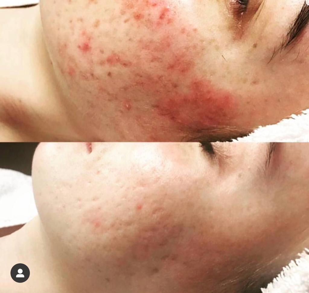 Vorher-Nachher-Vergleich: gerötete Gesichtshaut vor und nach 4 Hydrafacial-Behandlungen